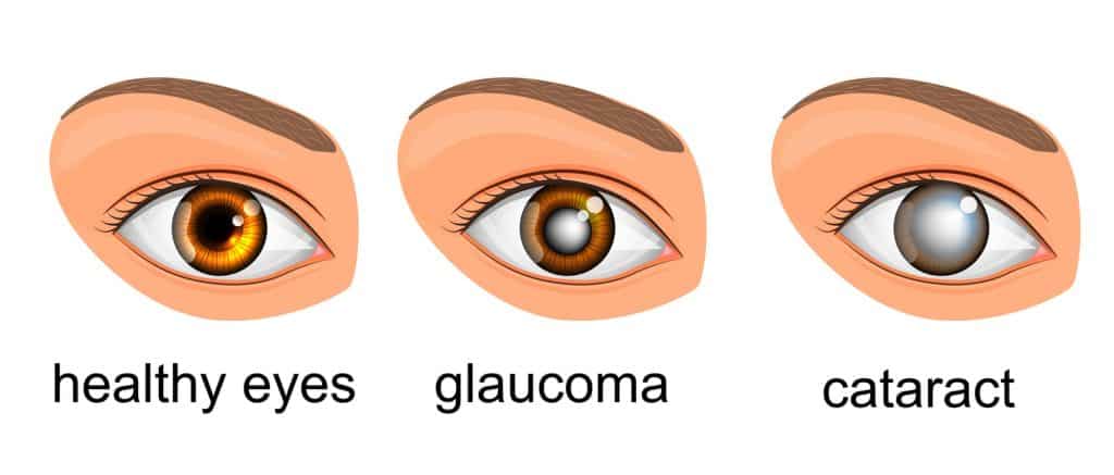 illustration of the difference between a healthy eye, an eye with glaucoma and one with cataract.